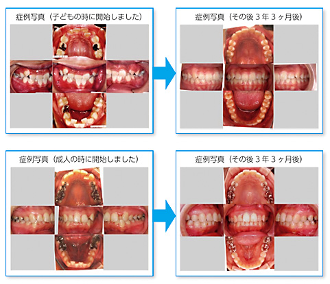 矯正歯科　SH療法